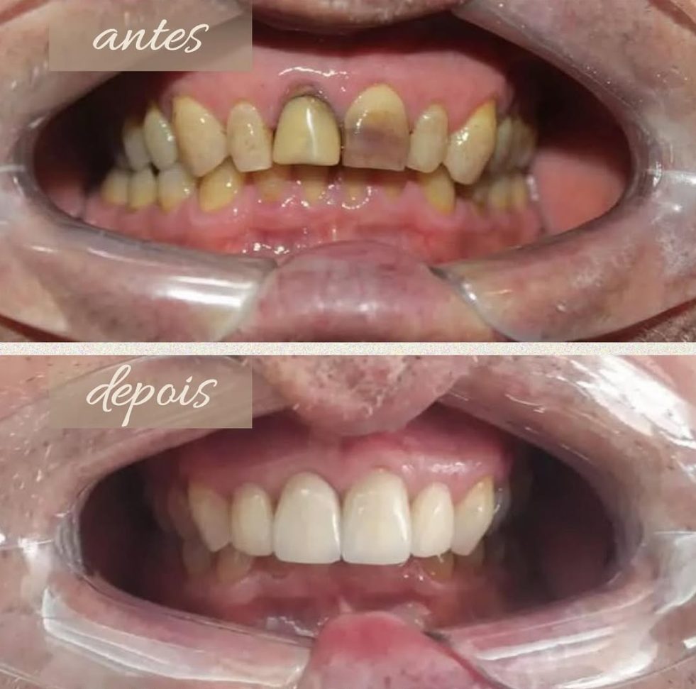 Antes: dentes da frente amarelados, um deles escurecido. Depois: dentes da frente superiores claros e uniformes.