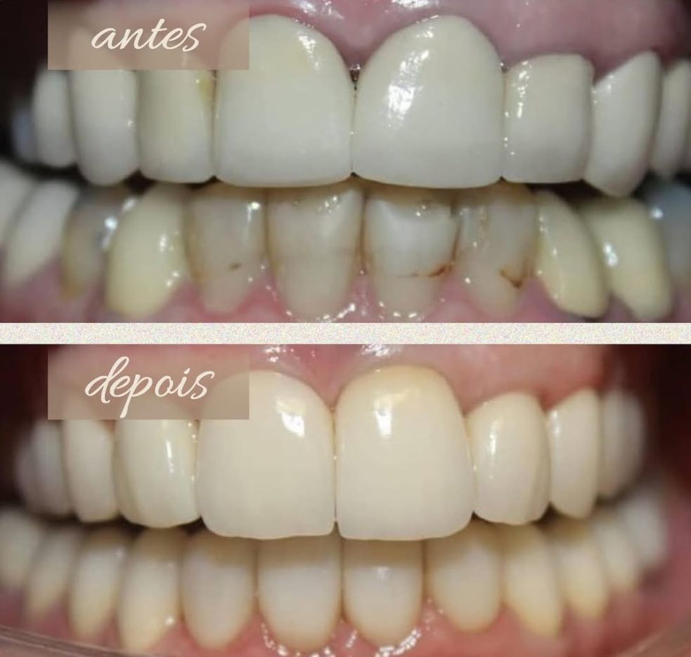 Antes: dentes inferiores com manchas e desgaste. Depois: dentes superiores e inferiores claros e alinhados.